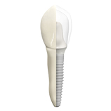Behandlungsablauf Zahnimplantat - Einsetzen des Implantates
