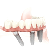 Behandlungsablauf Zahnimplantat - Definitive Prothetik