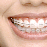 Festsitzende Zahnspange mit Brackets