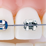 Brackets einer festsitzenden Zahnspange